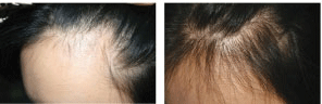 female-hair-loss-before-after.gif