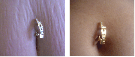 stretch-marks-before-after-2.gif