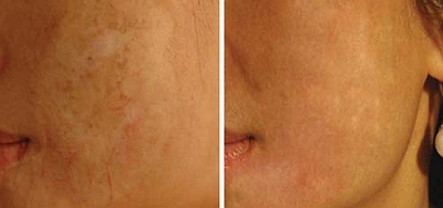 burn-scars-before-after-dermaroller.jpg